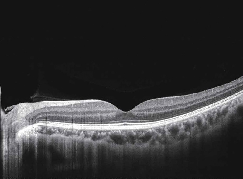 Deep Choroidal Imaging (DCI)